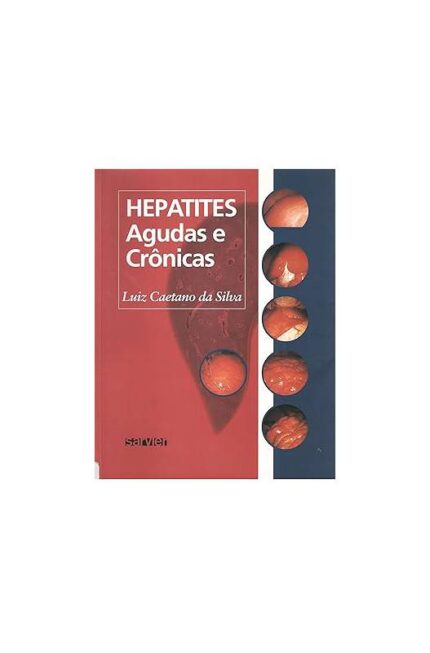 Hepatites Agudas e Crônicas 3ª Edição- Luiz Caetano da Silva